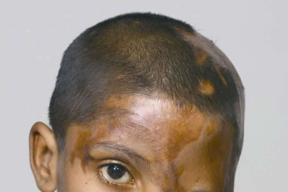 Julie, de 7 anos, foi agora ajudada pela Fundação Chhanv