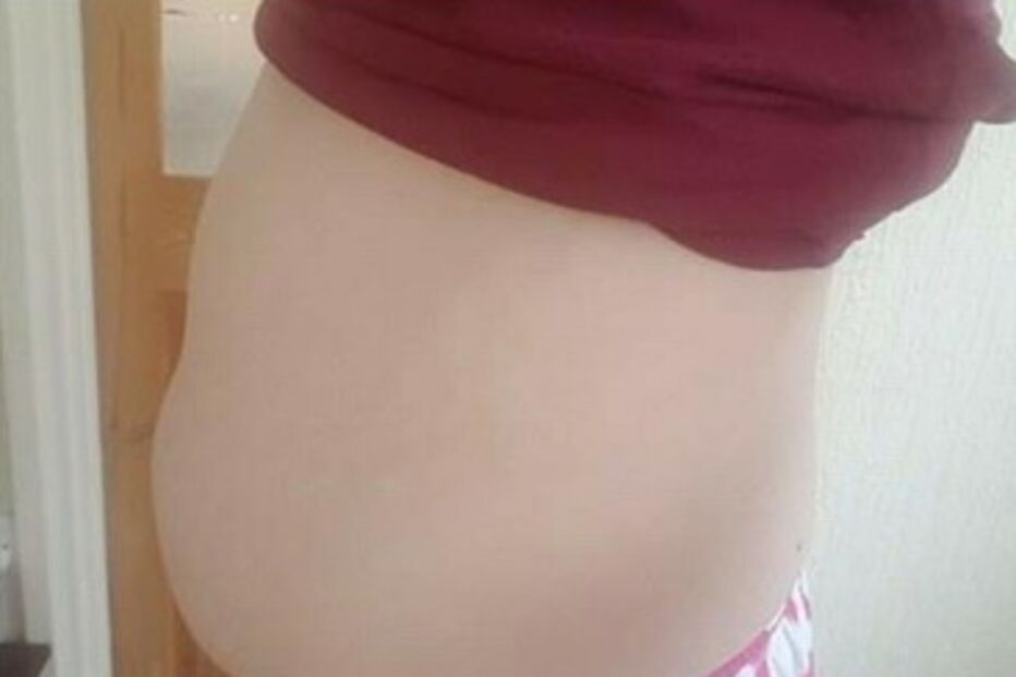 Mulher com endrometriose 