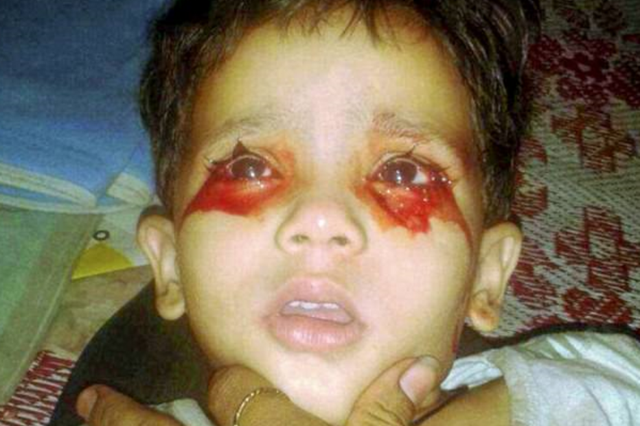 Menina de três anos chora lágrimas de sangue