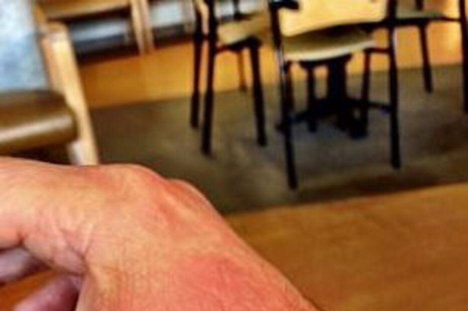 Fotodermatite causada por sumo de limão