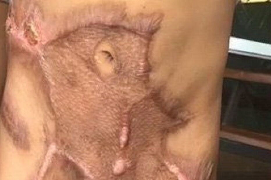 Criança de cinco anos sofreu queimaduras no abdomén, genitais e pernas