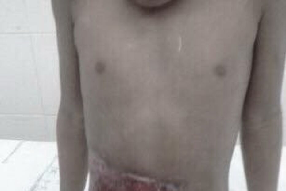 Criança de cinco anos sofreu queimaduras no abdomén, genitais e pernas