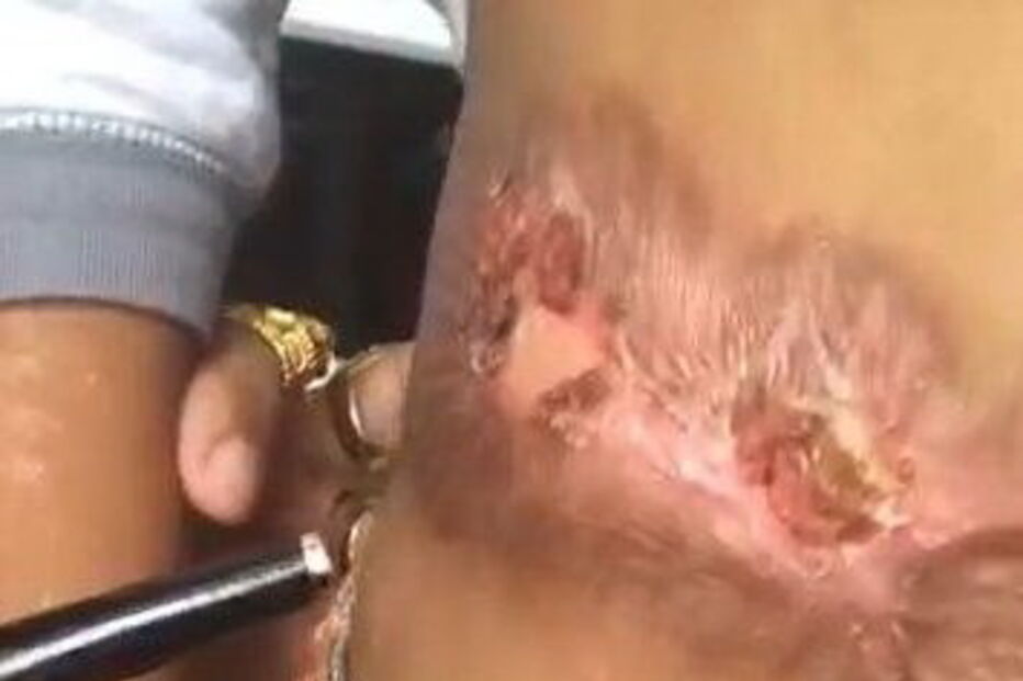 Criança de cinco anos sofreu queimaduras no abdomén, genitais e pernas