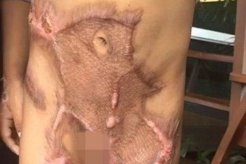 Criança de cinco anos sofreu queimaduras no abdomén, genitais e pernas