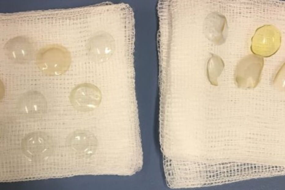 No total, os médicos retiraram 27 lentes de contacto de um olho da paciente