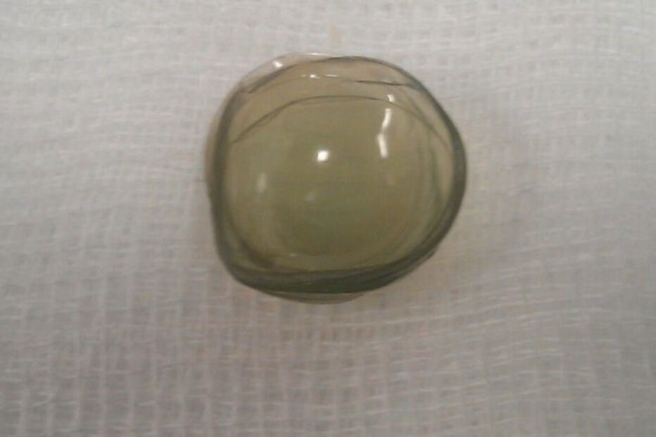 No total, os médicos retiraram 27 lentes de contacto de um olho da paciente