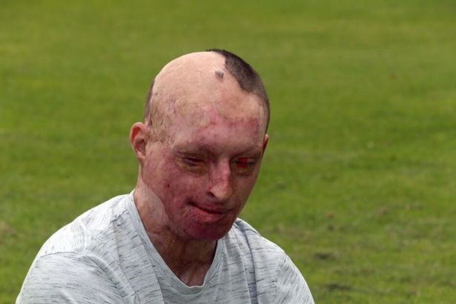 Vítima de ácido, Inglaterra, Daniel Rotariu