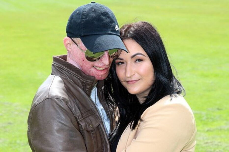 Vítima de ácido, Inglaterra, Daniel Rotariu