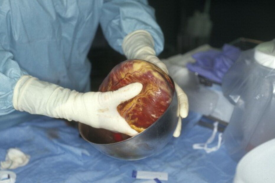 Transplante de coração