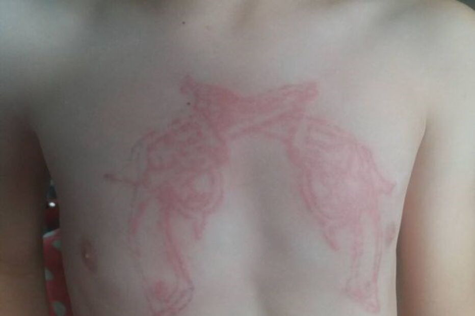 Menino de sete anos sofre queimaduras após fazer tatuagem de henna
