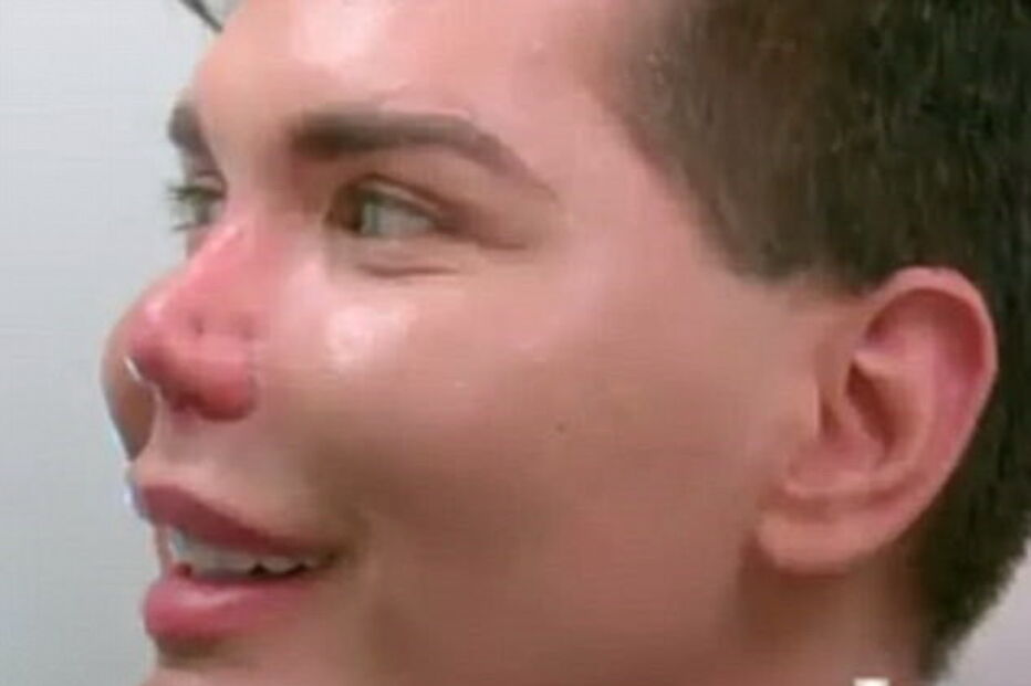 Ken humano, Rodrigo Alves, Botched