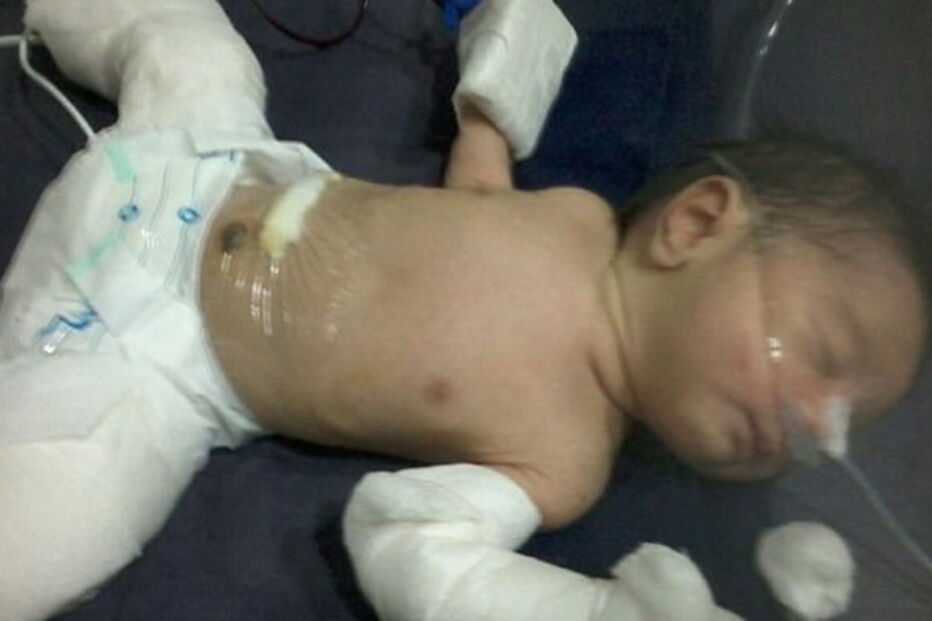 Bebé nasce grávido de irmão gémeo