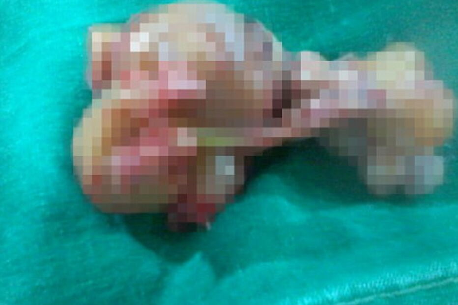 Bebé nasce grávido de irmão gémeo