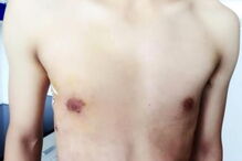 Man boobs, ginecomastia