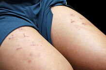 Howard Lam diz ter sido torturado na China e mostra agrafos nas pernas