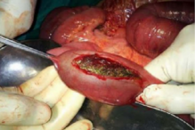 2017-08-11_14_55.18 hairball-rapunzel-syndrome-4.png