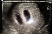 Casal foi obrigado a sacrificar gémeos siameses para salvar o filho, Thomas