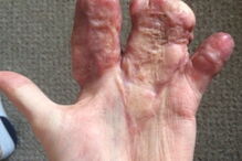 Antony teve que ser sujeito a uma série de operações nos últimos 12 meses