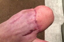 Antony teve que ser sujeito a uma série de operações nos últimos 12 meses