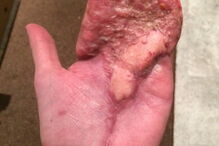 Antony teve que ser sujeito a uma série de operações nos últimos 12 meses