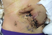 Antony teve que ser sujeito a uma série de operações nos últimos 12 meses