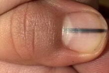 Lisa detetou uma mancha escura na unha da cliente