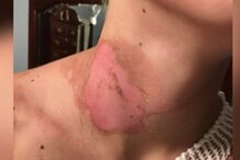 Adolescente de 15 anos ficou com queimaduras graves após brincadeira de amigos