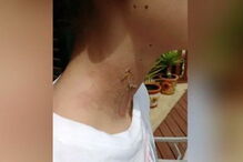 Adolescente de 15 anos ficou com queimaduras graves após brincadeira de amigos