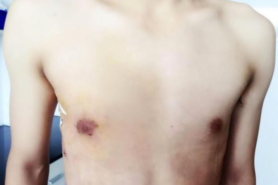 Man boobs, ginecomastia