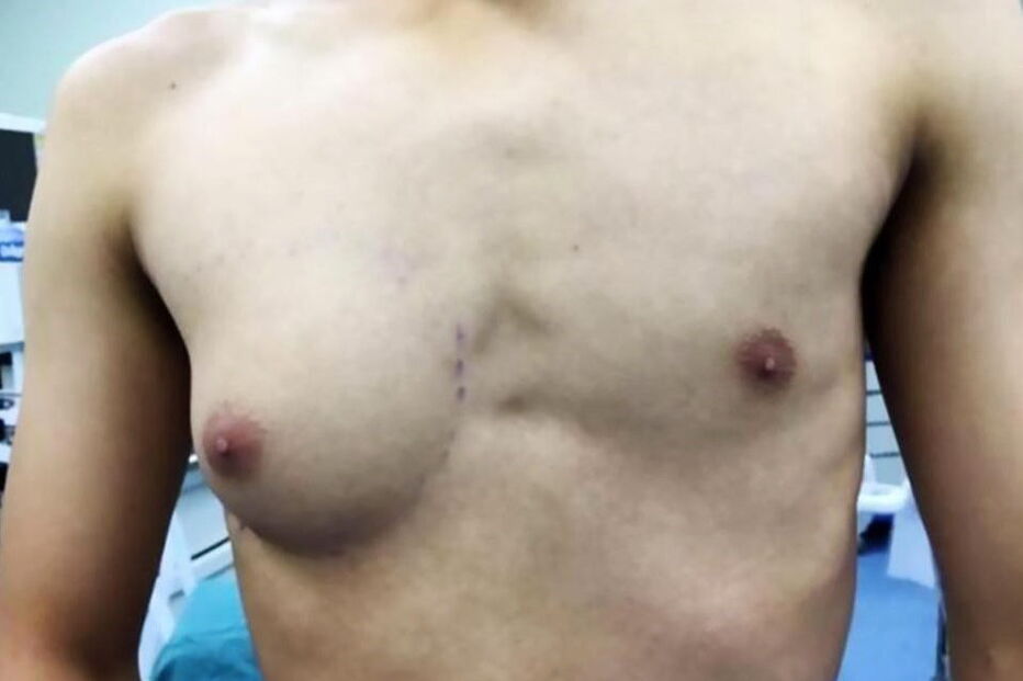 Man boobs, ginecomastia