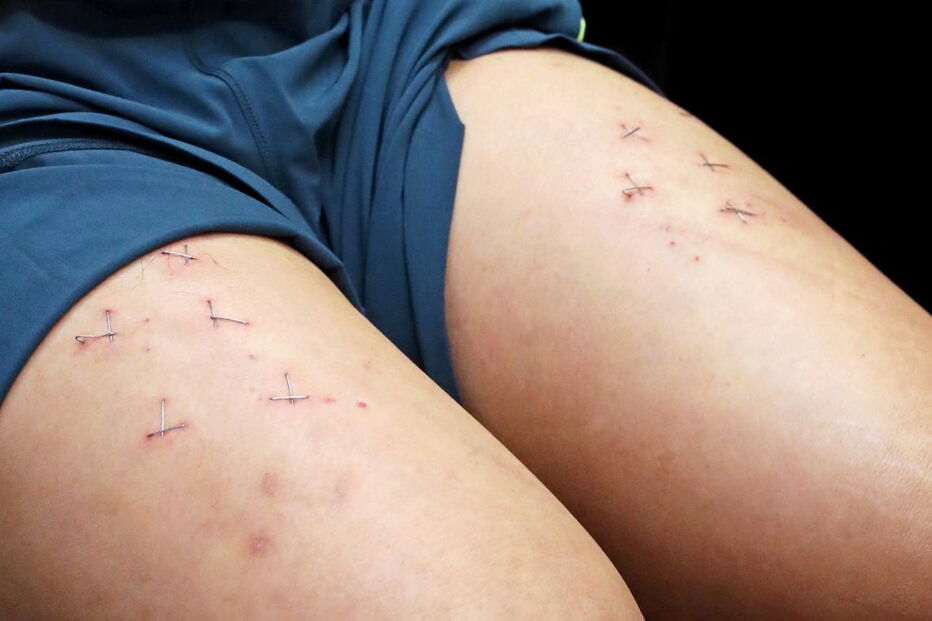 Howard Lam diz ter sido torturado na China e mostra agrafos nas pernas