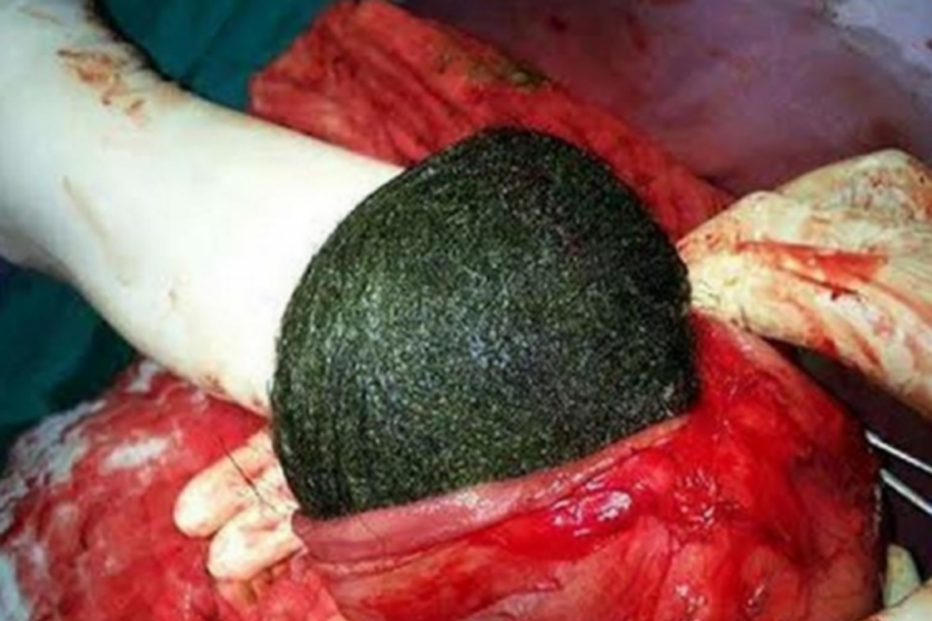 Retiraram uma bola de cabelo com cerca de 15 centímetros