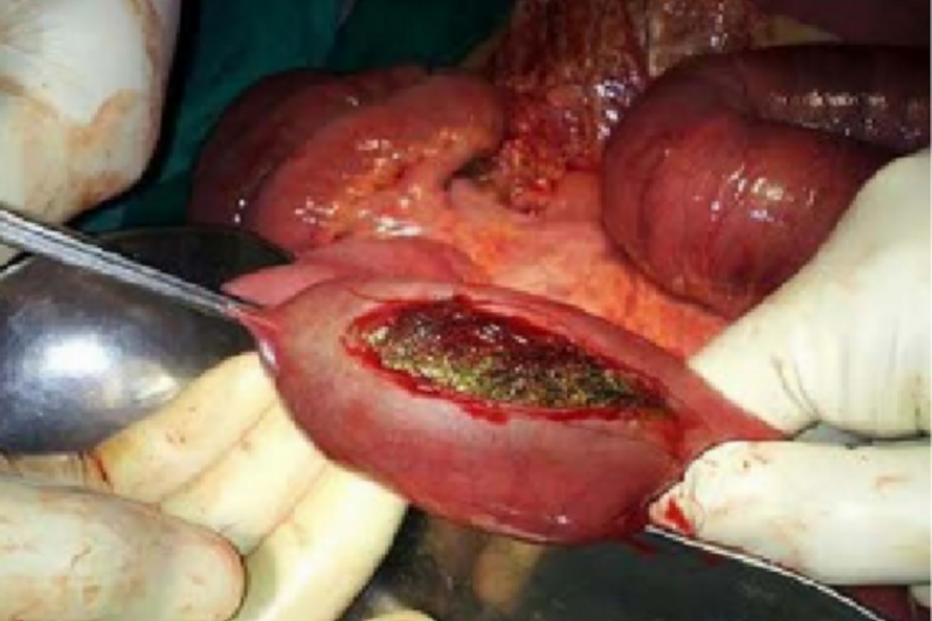 2017-08-11_14_55.18 hairball-rapunzel-syndrome-4.png