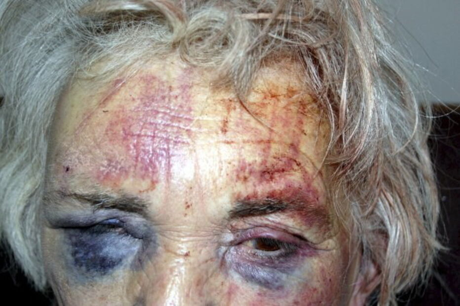 Idosa foi brutalmente espancada