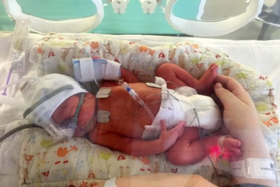 Casal foi obrigado a sacrificar gémeos siameses para salvar o filho, Thomas