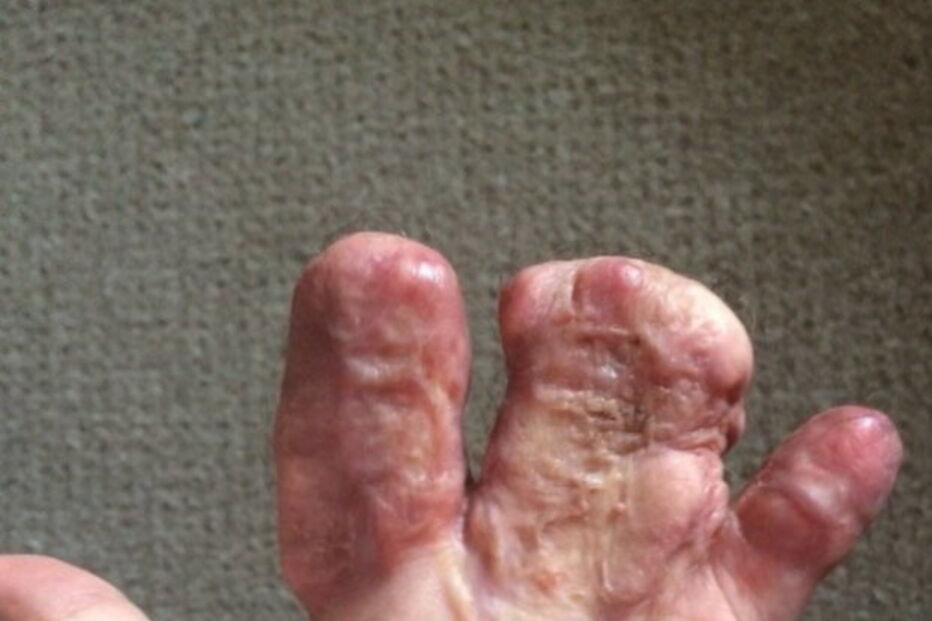 Antony teve que ser sujeito a uma série de operações nos últimos 12 meses