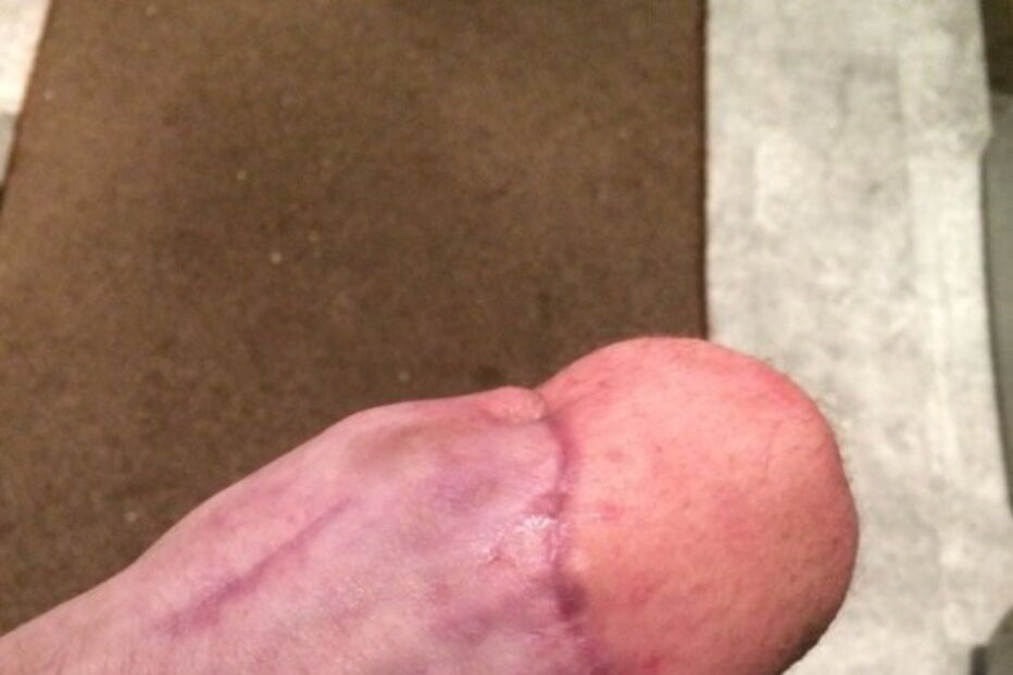 Antony teve que ser sujeito a uma série de operações nos últimos 12 meses