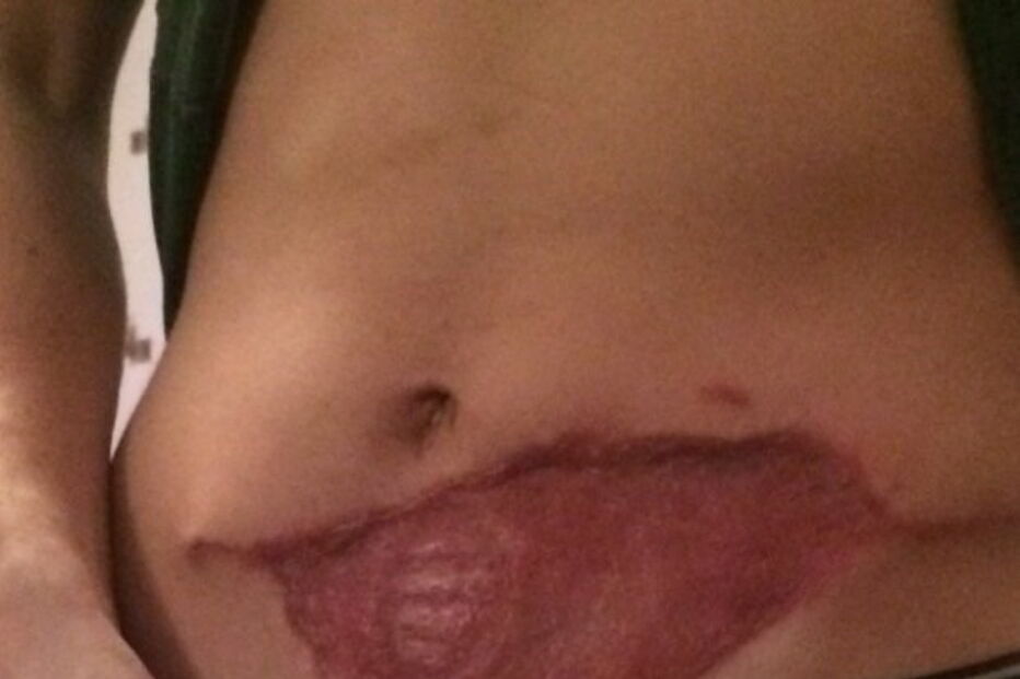 Antony teve que ser sujeito a uma série de operações nos últimos 12 meses