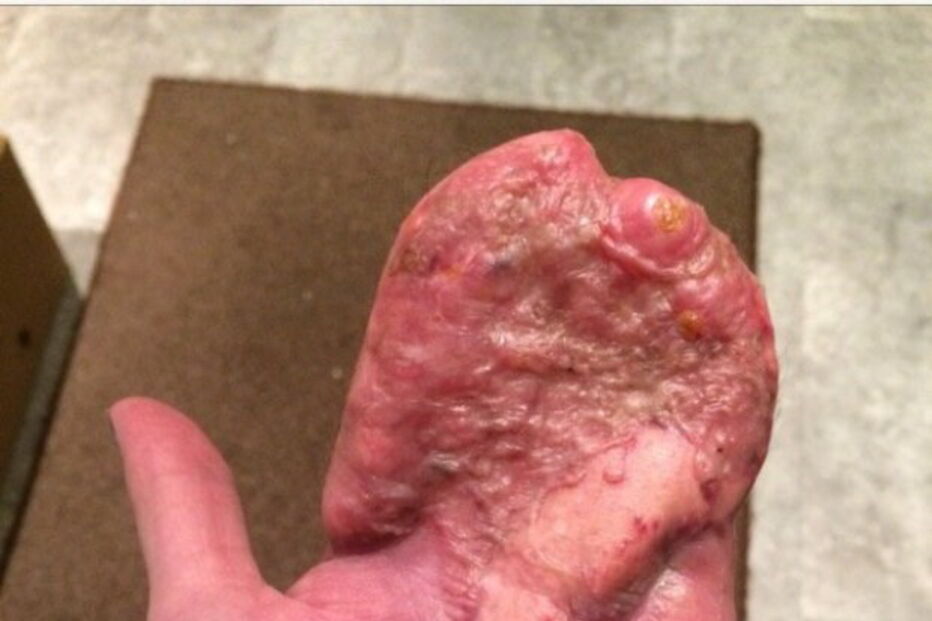 Antony teve que ser sujeito a uma série de operações nos últimos 12 meses