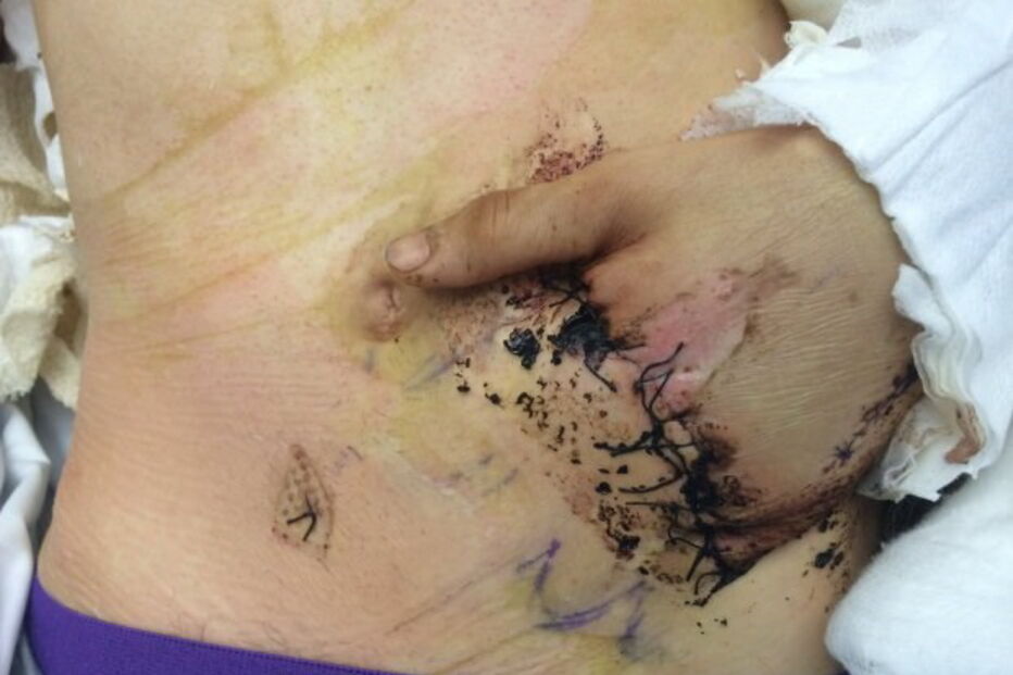 Antony teve que ser sujeito a uma série de operações nos últimos 12 meses