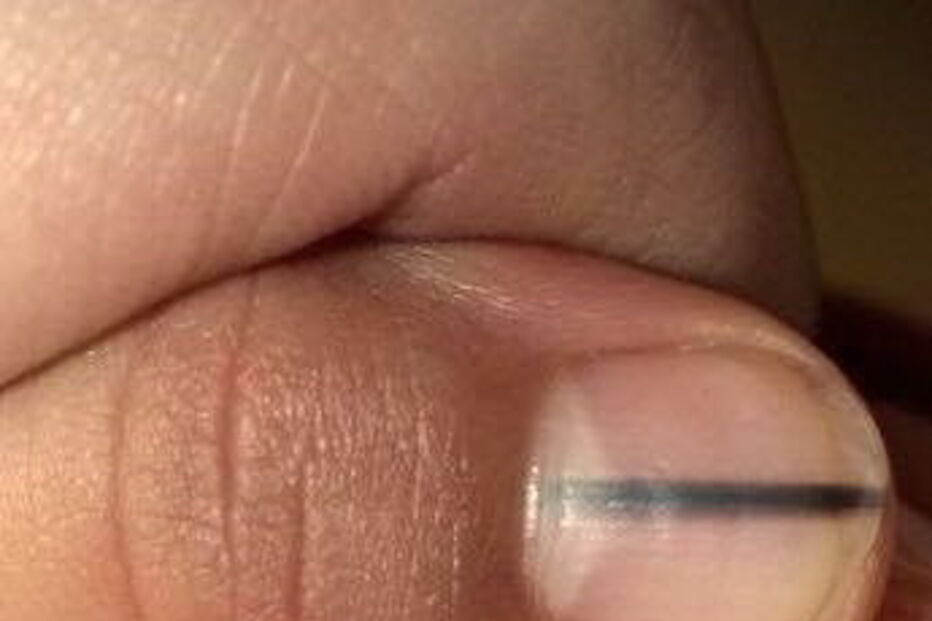 Lisa detetou uma mancha escura na unha da cliente