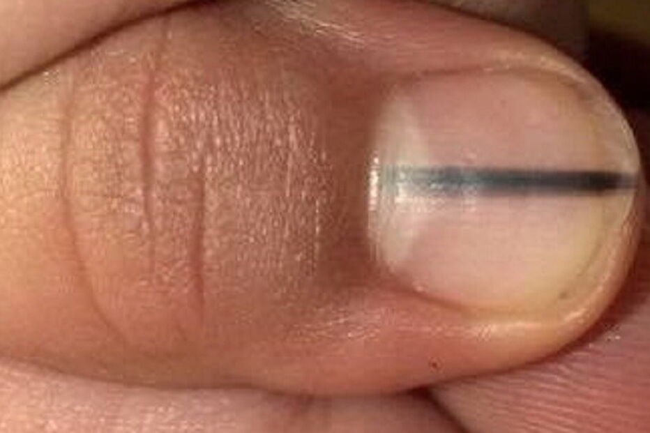 Lisa detetou uma mancha escura na unha da cliente