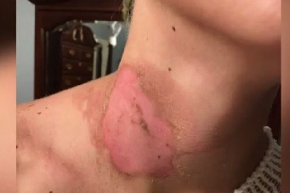 Adolescente de 15 anos ficou com queimaduras graves após brincadeira de amigos