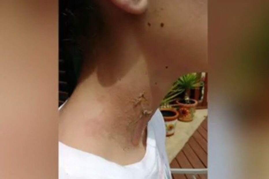 Adolescente de 15 anos ficou com queimaduras graves após brincadeira de amigos