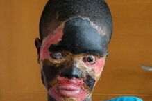 Atsede foi atacada com ácido pelo marido