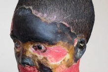 Atsede foi atacada com ácido pelo marido