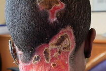 Atsede foi atacada com ácido pelo marido