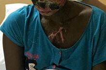 Atsede foi atacada com ácido pelo marido