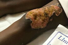 Atsede foi atacada com ácido pelo marido