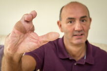 Jeremy Payton substituiu dedos da mão pelos dos pés